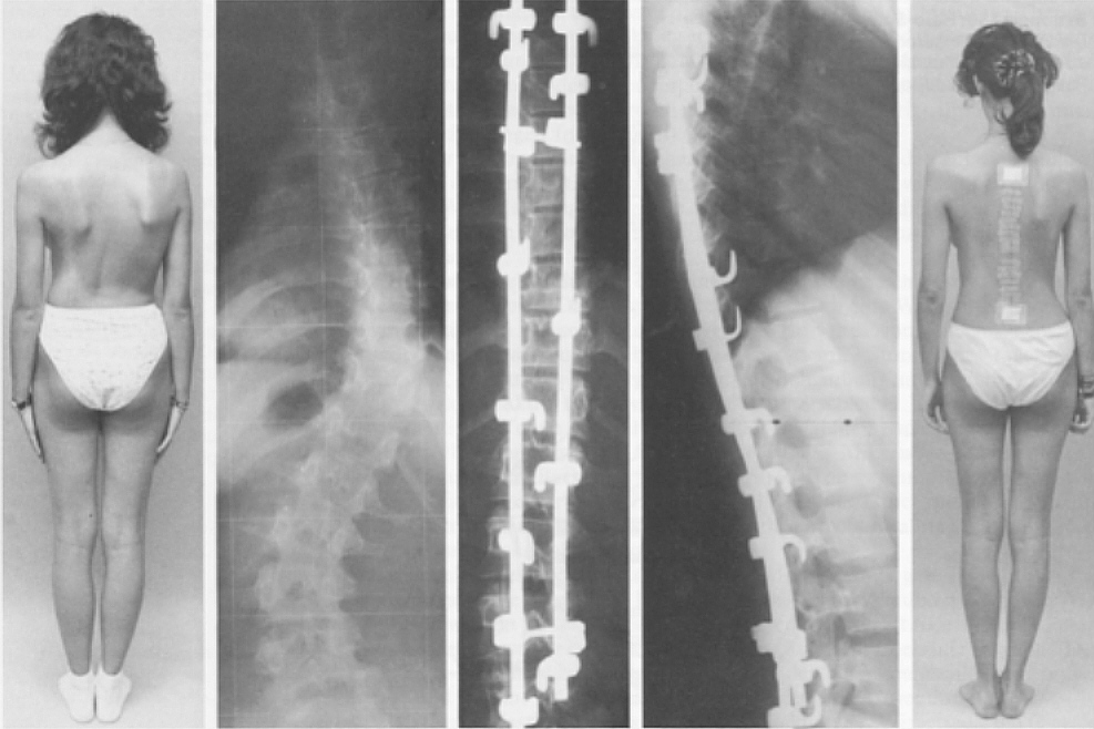 Сколиоз позвоночника 4 степени фото